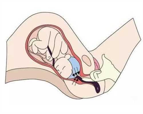 剖宫产妈妈想生二胎？能不能生得看这些！